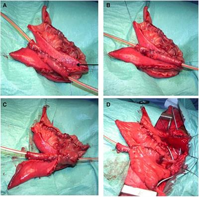 A catheterizable serous-lined urinary outlet associated with the ileal bladder augmentation Abol-Enein and Ghoneim procedure: a safe and reliable procedure in children